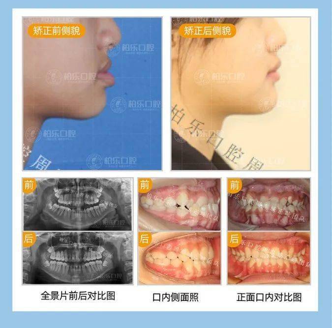 马德隆畸形可以最新治