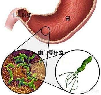 幽门螺杆菌的最新治疗方法